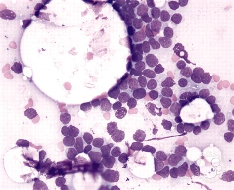 Precursor T Cell Acute Lymphoblastic Leukemia 1