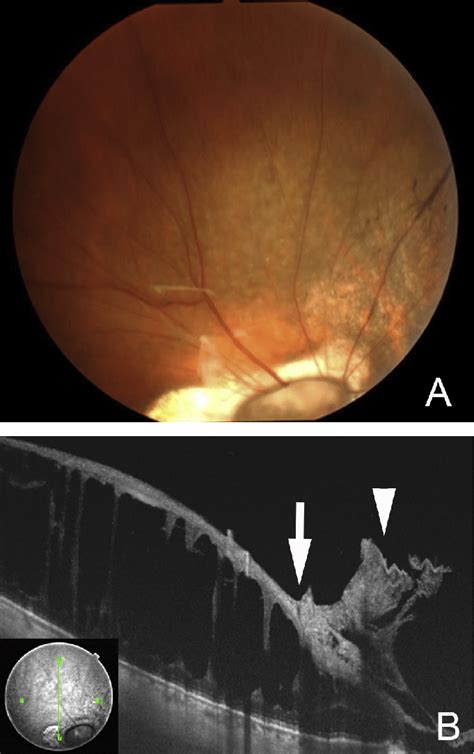Preoperative Fundus Photograph And Swept Source Optical Coherence