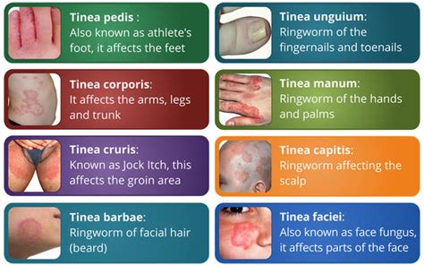 Dr Ajays Homeopathy Homeopathy Is Best For Recurrent Fungal