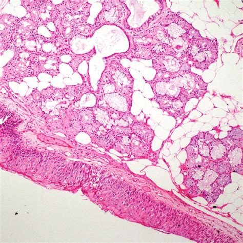 The Commonest Histological Types Of Minor Salivary Gland Tumors
