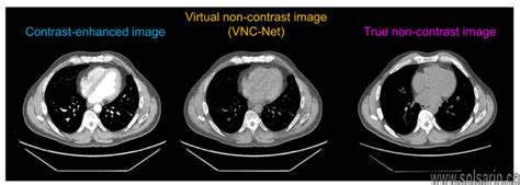 Difference Between Contrast And Noncontrast Ct Scan Solsarin