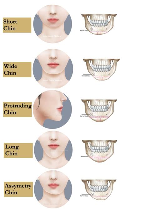 Genioplasty Your Guide To Chin Surgery In South Korea Seoul Guide