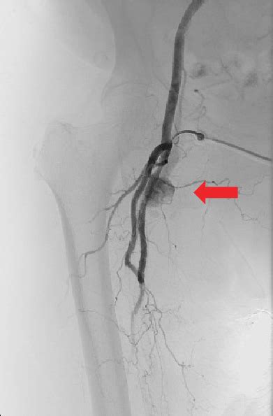 Right Limb Arteriogram With A Pseudoaneurysm Of The Right Superficial