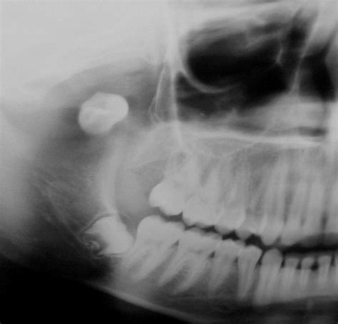 Panoramic Radiograph Showing A Superior And Posterior Dislocation Of