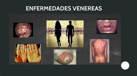 Enfermedades Venereas By Camila Reyes On Prezi