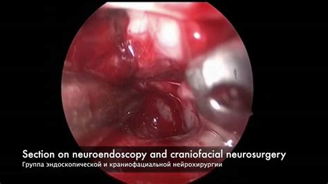 Its nerve fibers carry messages between the cerebrum and the rest of the body. Removal the tumor of the brain stem. Endoscopic ...