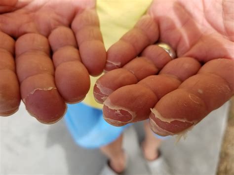 Can Fishing And Saltwater Make Your Hands Peel