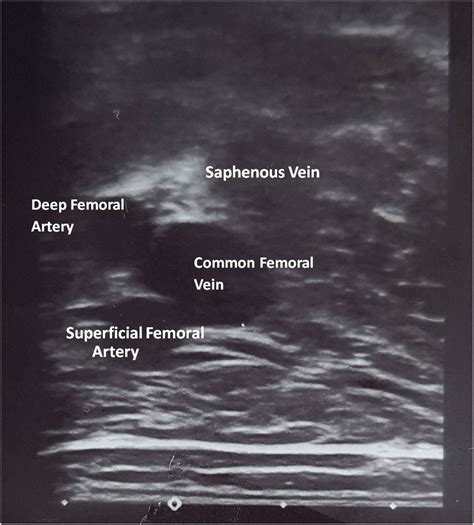 Doppler Ultrasound Images Of The Lower Right Limb Showing A Superficial