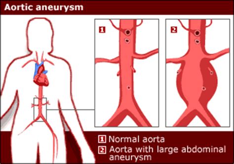 The most important types, arteries and veins, carry all blood vessels have the same basic structure. BBC NEWS | Health | Blood vessel scans would save lives
