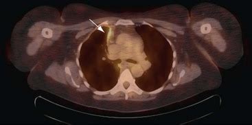 The nature of this hybrid imaging enables diagnosis and. Pleural Effusion, Empyema, and Pneumothorax | Thoracic Key