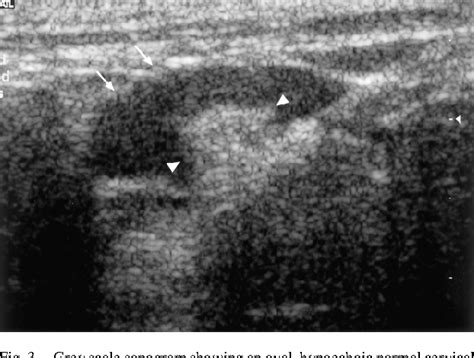 Figure 3 From Sonography Of Neck Lymph Nodes Part Ii Abnormal Lymph