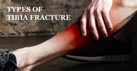 Types Of Tibia Fracture Welcome To Sys Medtech International Pvt Ltd