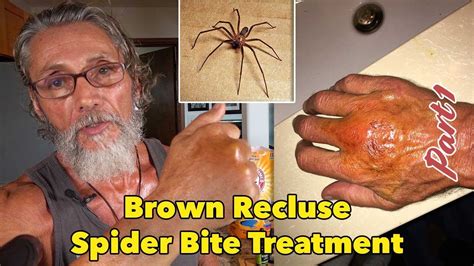 Brown Recluse Spider Bite Treatment Part 1 Dr Robert Cassar Youtube