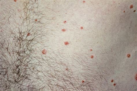 Guttate Psoriasis On The Body Stock Image C0169272 Science Photo