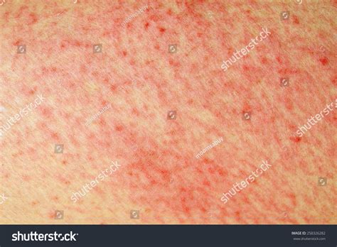 Raised Red Bumps Blisters Caused By Stock Photo 258326282 Shutterstock