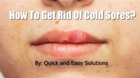 How To Get Rid Of A Cold Sore Fast Complete Howto Wikies
