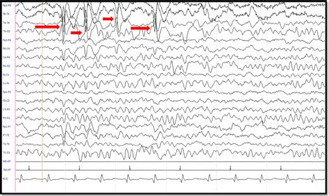 Eeg Waveforms