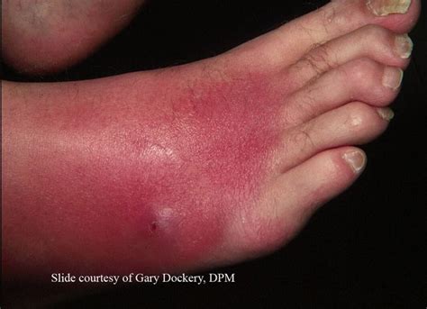 Cellulitis Infection Pictures