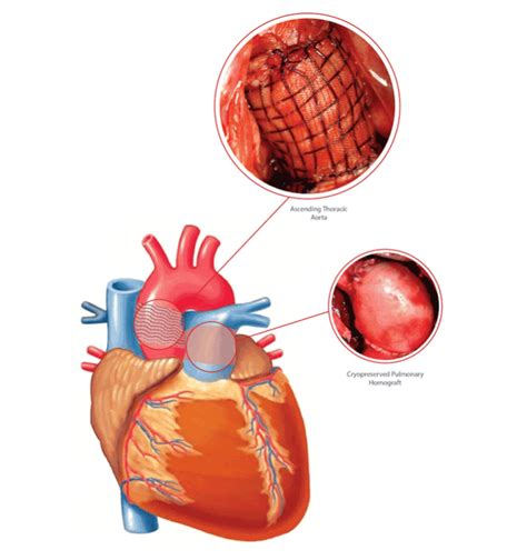 The use of Bioresorbable Scaffolds in Cardiovascular Surgery | Cardiovascular, Chd, Surgery