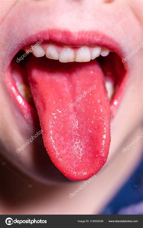 Tongue Of A Child With Scarlet Fever Strawberry Tongue Stock Photo By