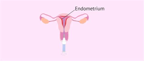 Uterine Curettage Procedure Recovery And Complications