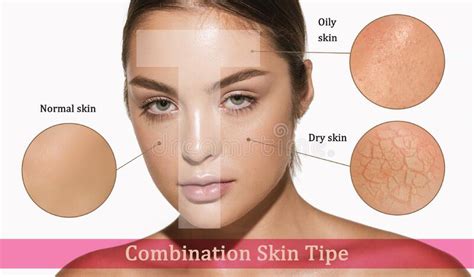 Types Acne Woman Stock Photos Free And Royalty Free Stock Photos From