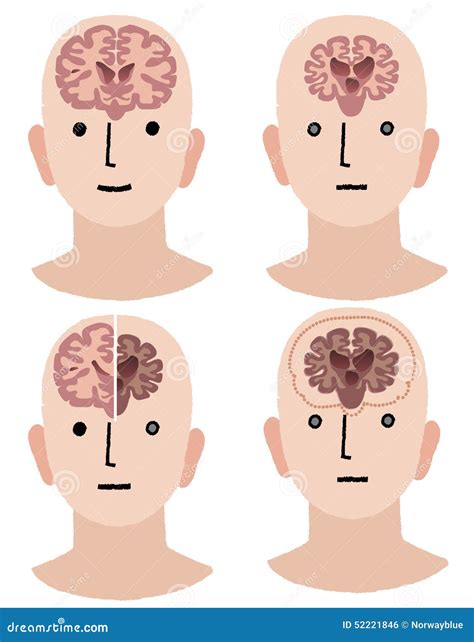 Gehirne Der Demenz Und Des Gesunden Mannes Vektor Abbildung