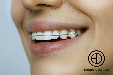 Some orthodontists prefer using fixed retainers, which are wires that are glued to the bakcs of teeth, and hold front teeth together. Why Retainer Wear is Important - HD Orthodontics Long Beach