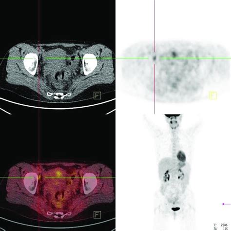 Fdg Petct Scan Axial Ct Pet And Fusion Cross Sections As Well As