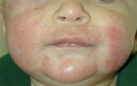 Dermatitis Atópica Sociedad De Pediatría De Atención Primaria De