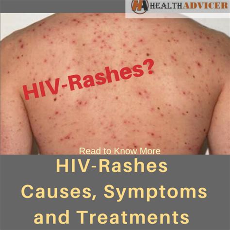 rashes causes symptoms and treatment express er