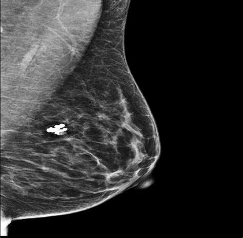Benign Osseous Metaplasia Of The Breast Case Report Abstract