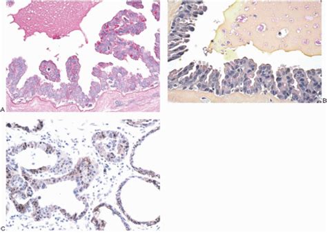 Benign Proliferative Lesions Of The Male Breast Basicmedical Key