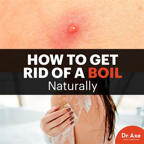 Hot To Get Rid Of A Boil And How To Prevent Boils Dr Axe