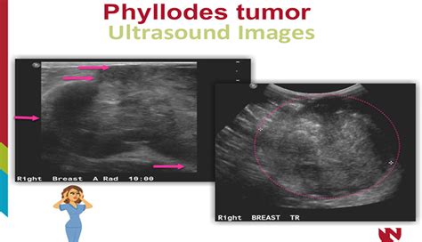 Phyllodes Tumor A Breast Pathology Case Study E Gallery University