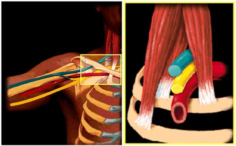Thoracic Outlet Syndrome Doctor Los Angeles Thoracic Outlet Syndrome
