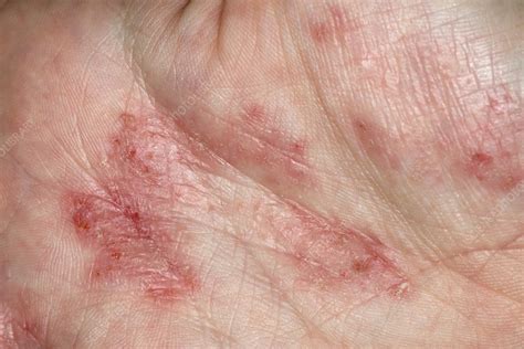 Eczema On The Palm Stock Image C0213302 Science Photo Library