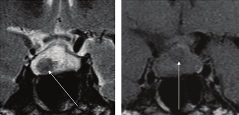 Case 17 Nonenhanced Coronal Mri Images Of Rcc A T2 Weighted Image