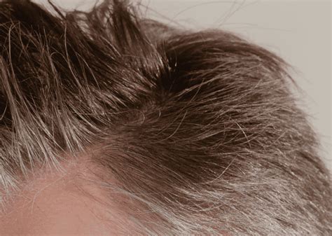 Male Pattern Baldness Symptoms And Treatments Keeps