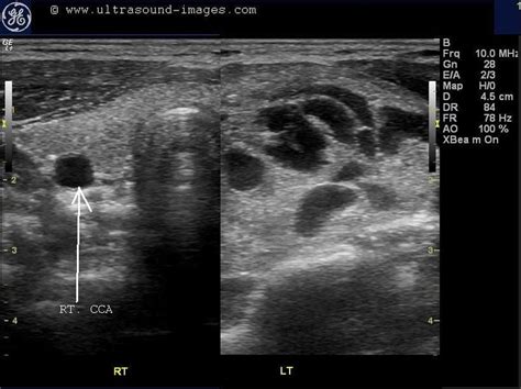 Multinodular Goiter Ultrasound