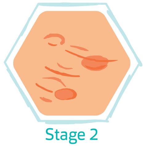 Hidradenitis Suppurativa Stage 2 Hs Stages Hidrawear