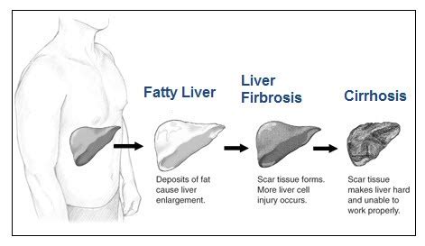 Stages Of Alcoholic Liver Disease