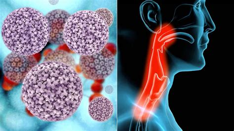 5 Things To Know About Hpv Related Throat Cancer Everyday Health