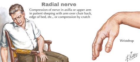 Saturday Night Palsy Compression Of Radial Nerve In Grepmed