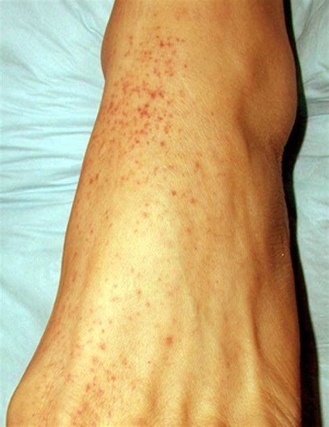 Petechial Rash Good Health