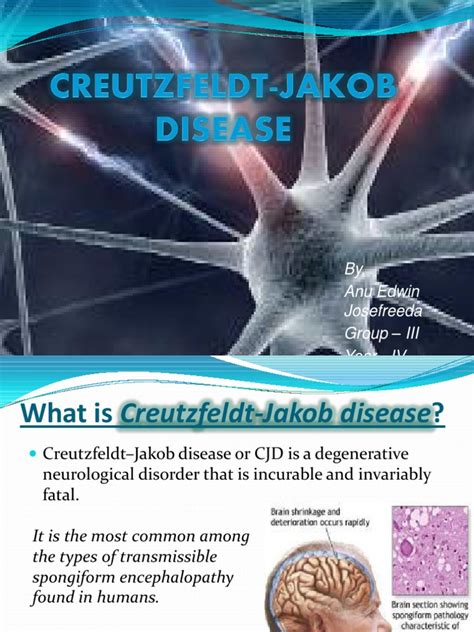Creutzfeldt Jakob Disease 1 Pdf Human Diseases And Disorders