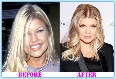 Fergie Plastic Surgery Before And After Fergie Plastic Surgery