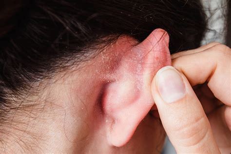 How To Get Rid Of Pimples Behind The Ears Bye Ear Acne