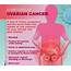 Unusual Symptoms Of Ovarian Cancer  News Update