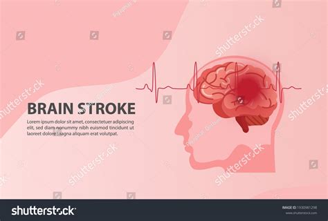 Scientific Medical Illustration Human Brain Stroke Stock Vector